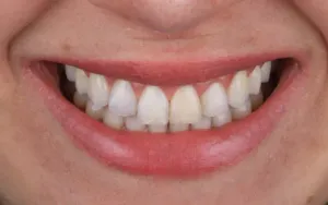 Antes - Dente Escurecido